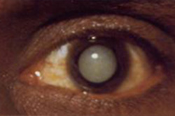 Eye(cataract)